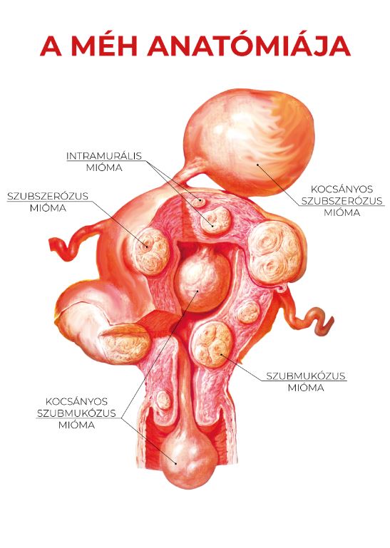 kismeret miomatipusok